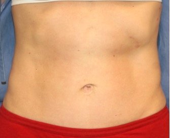 Tummy Tuck San Diego 120 - after - oblique