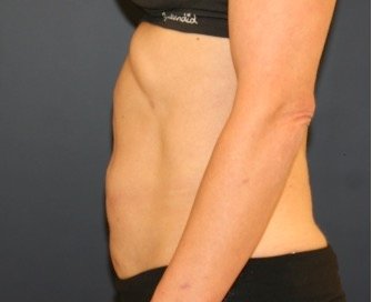 Tummy Tuck San Diego 120 - before - side