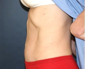 Tummy Tuck San Diego 120 - after - side