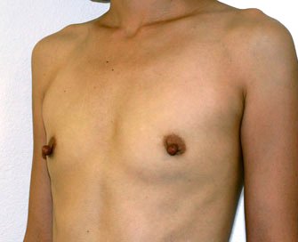 Breast Augmentation Case 22 - before - angle