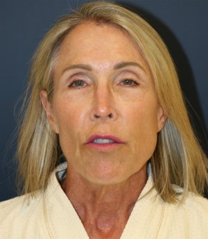 Facial Rejuv San Diego - before - front