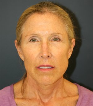 Facial Rejuv San Diego - after - front