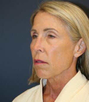 Facial Rejuv San Diego - before - oblique