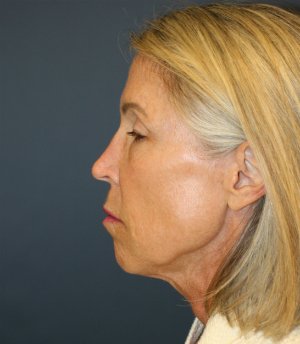 Facial Rejuv San Diego - before - side