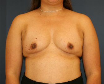 Breast Augment 540cc saline - before - front