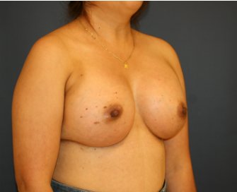 Breast Augment 540cc saline - after - oblique