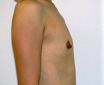 Breast Augmentation Case 22 - before - side
