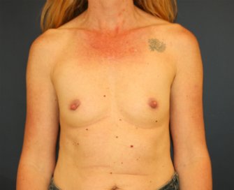 Breast Aug Mod Plus Profile 385 - before - front