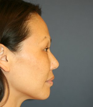 Rhinoplasty Asian - before - front