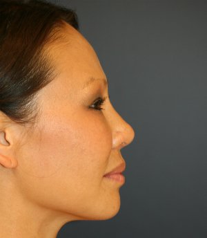 Rhinoplasty Asian - after - front