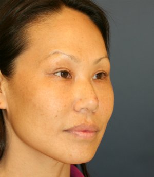 Rhinoplasty Asian - before - oblique