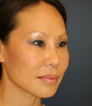 Rhinoplasty Asian - after - oblique