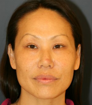 Rhinoplasty Asian - before - side
