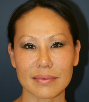 Rhinoplasty Asian - after - side