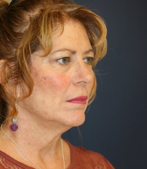 Neck Lift Surgery San Diego - before - oblique