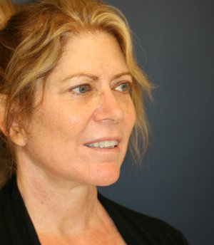 Neck Lift Surgery San Diego - after - oblique