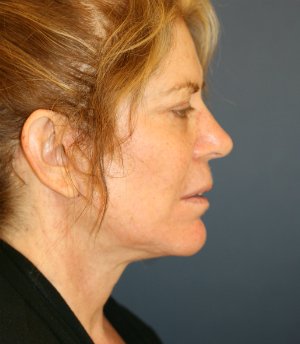 Neck Lift Surgery San Diego - after - front