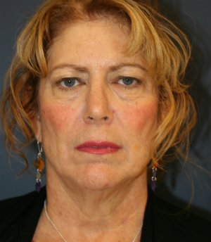 Neck Lift Surgery San Diego - before - side
