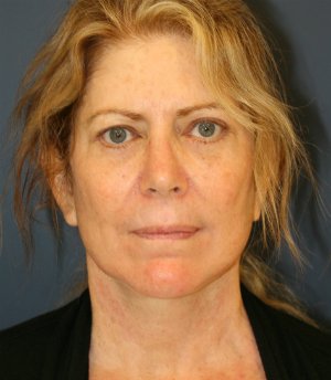 Neck Lift Surgery San Diego - after - side