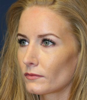 Revision Rhinoplasty 28 - after - oblique