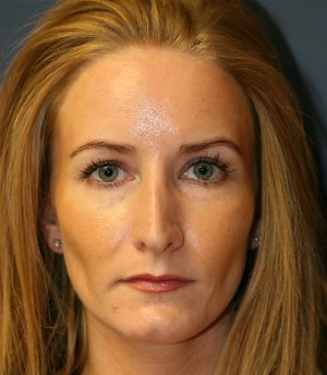 Revision Rhinoplasty 28 - before - side