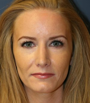 Revision Rhinoplasty 28 - after - side
