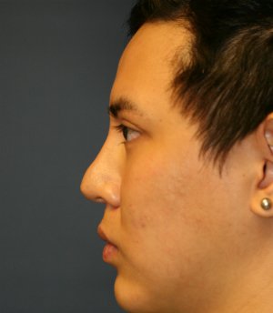 Revision Rhinoplasty 39 - before - front