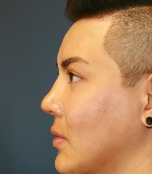 Revision Rhinoplasty 39 - after - front