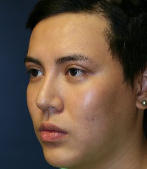 Revision Rhinoplasty 39 - before - oblique