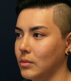 Revision Rhinoplasty 39 - after - oblique