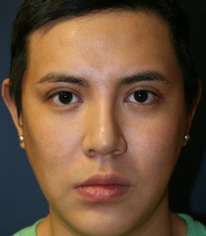 Revision Rhinoplasty 39 - before - side