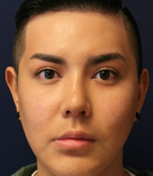 Revision Rhinoplasty 39 - after - side