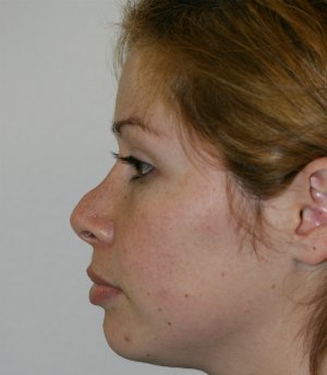 Two Weeks After Revision - before - front