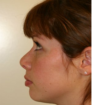 Two Weeks After Revision - after - front