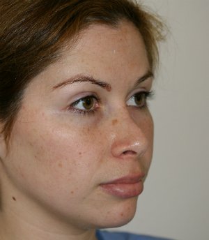 Two Weeks After Revision - before - oblique left