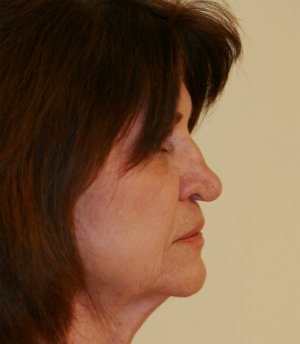 Six Weeks after Nose Revision - before - oblique
