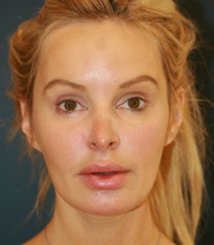 Revision Rhinoplasty 56 - before - front