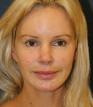 Revision Rhinoplasty 56 - after - front