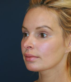 Revision Rhinoplasty 56 - before - oblique