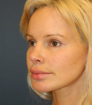Revision Rhinoplasty 56 - after - oblique
