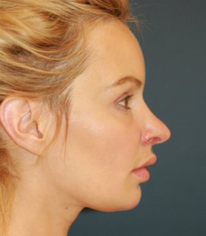 Revision Rhinoplasty 56 - before - side