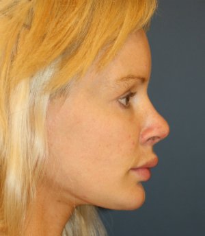 Revision Rhinoplasty 56 - after - side