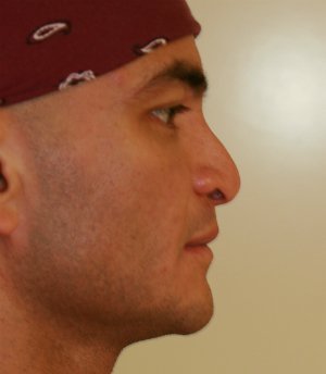 Cleft Lip Nose Revision - before - front
