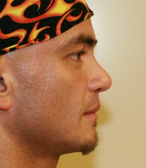 Cleft Lip Nose Revision - after - front