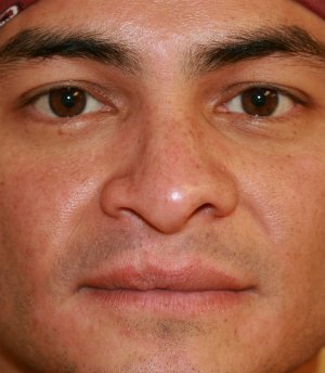 Cleft Lip Nose Revision - before - oblique