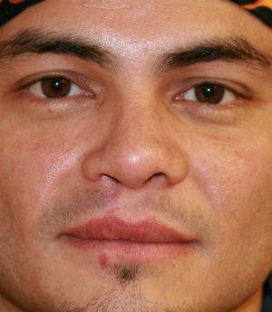 Cleft Lip Nose Revision - after - oblique
