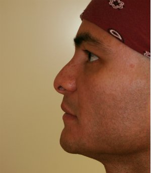 Cleft Lip Nose Revision - before - side