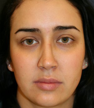 Revision Rhinoplasty 32 - before - front