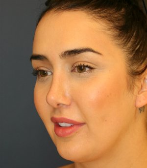Revision Rhinoplasty 32 - after - oblique