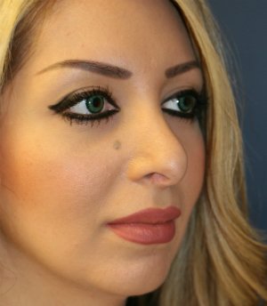 Nostril Reduction - before - front